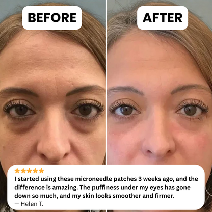 Nuvéra™ Microneedle Patches